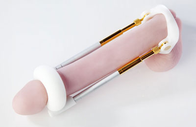 Penis Enlargement Device – An Overview – Size Extender